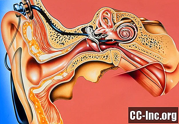 Geschiedenis van het cochleair implantaat