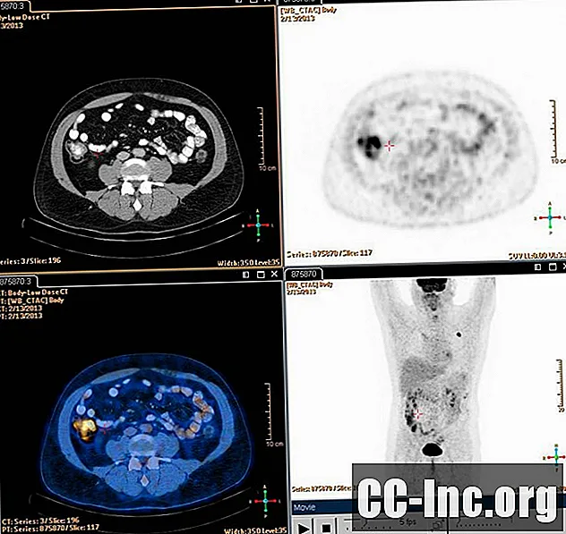 Hodgkinov limfom i uloga PET / CT-a
