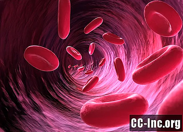 Come viene trattata l'anemia