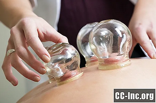 Hoe cupping verlichting kan brengen voor fibromyalgie