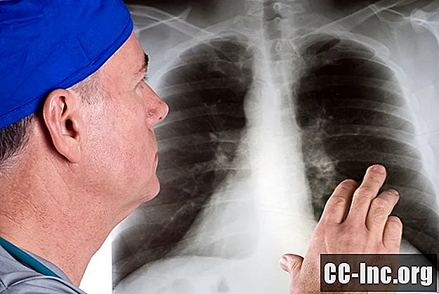 Kaip diagnozuojamas plaučių vėžys