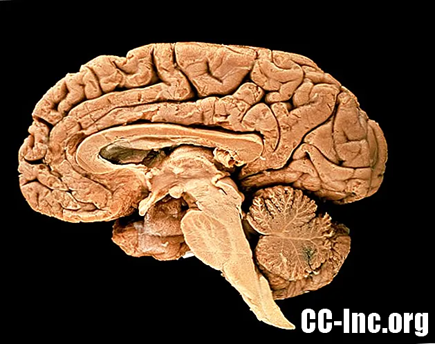 Bagaimana MS Mempengaruhi Batang Otak