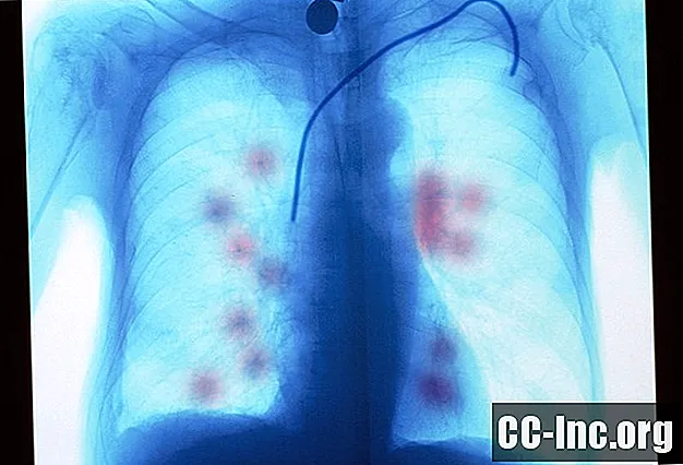 Hoe uitgezaaide kanker naar de longen verschilt van primaire longkanker