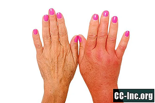 Come l'artrite psoriasica colpisce le mani