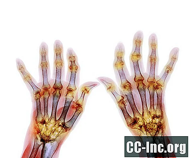 Hoe reumatoïde artritis elk deel van het lichaam beïnvloedt