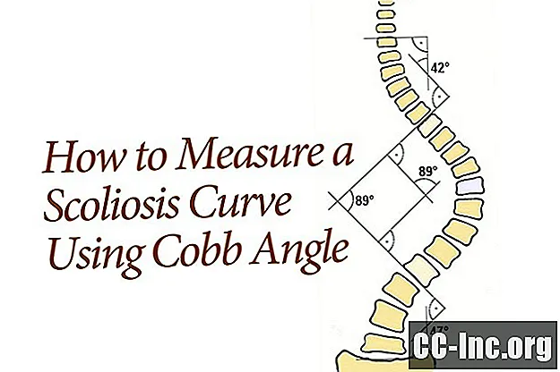 脊柱側弯症をコブ角で測定する方法