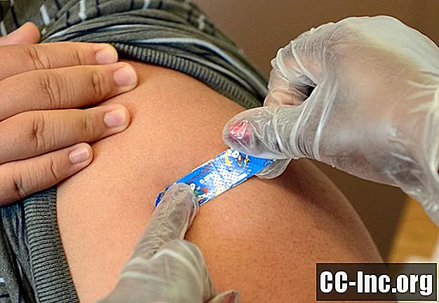 天然痘の治療方法