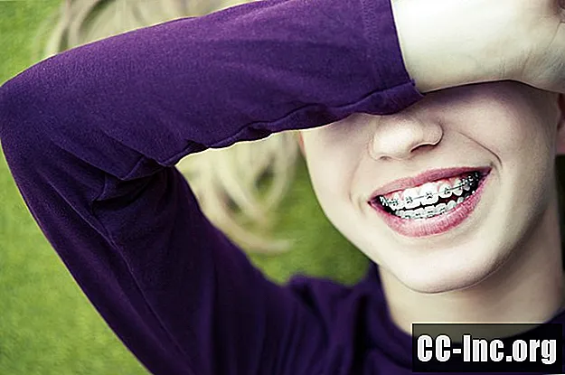 Làm thế nào để giảm bớt nỗi sợ hãi về việc niềng răng - ThuốC