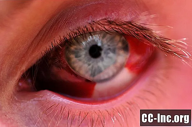 Причины кровавых слез или гемолакрии