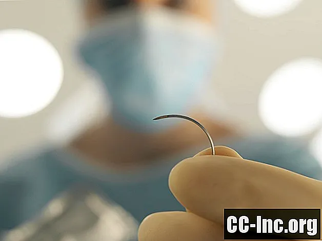 Cómo cuidar las suturas solubles