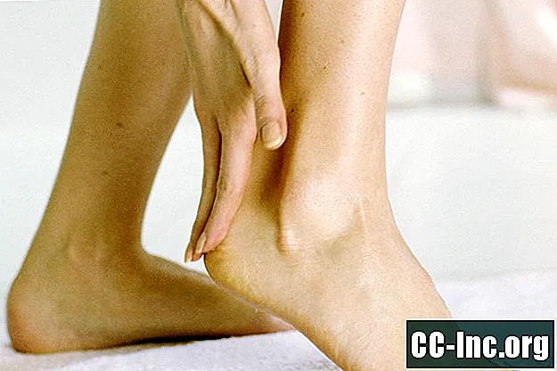 Làm thế nào để đối phó với da khô và vết nứt trên bàn chân của bạn