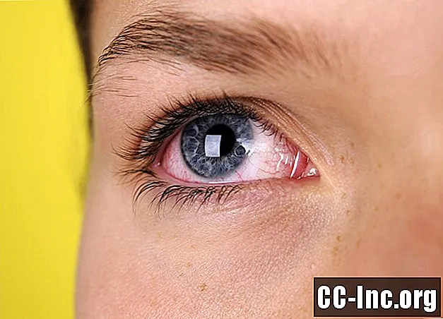 Як видалити сторонній предмет з ока