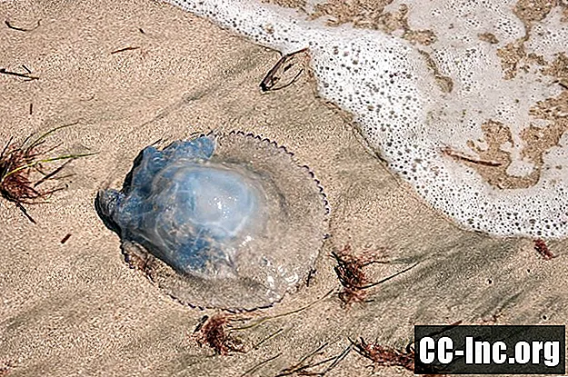 Как да лекуваме ужилване от медузи