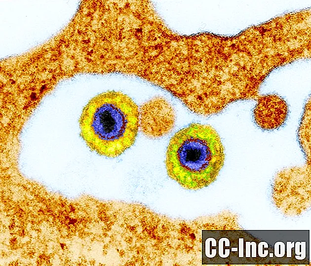Humani herpesvirus 6 (HHV-6) povezuje s brojnim bolestima