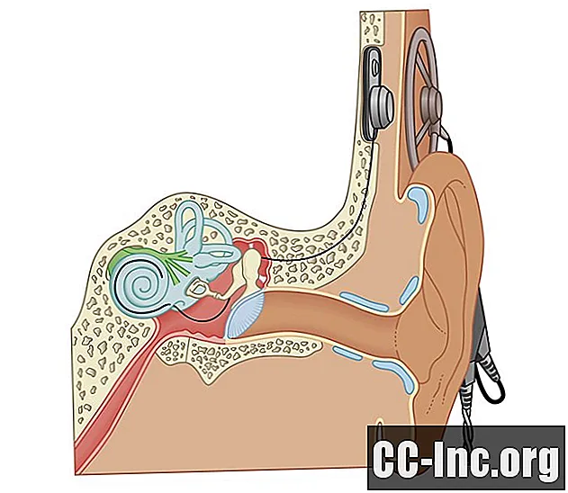 Hybride cochleaire implantaten