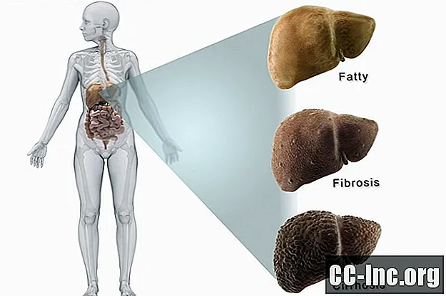 IBD ve Karaciğer Hastalığı