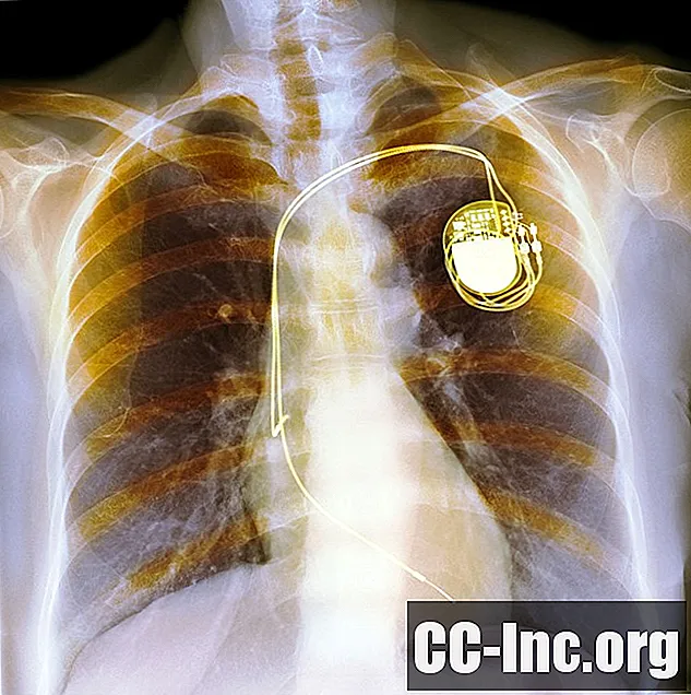 Komplikacije implantabilnog kardioverterskog defibrilatora
