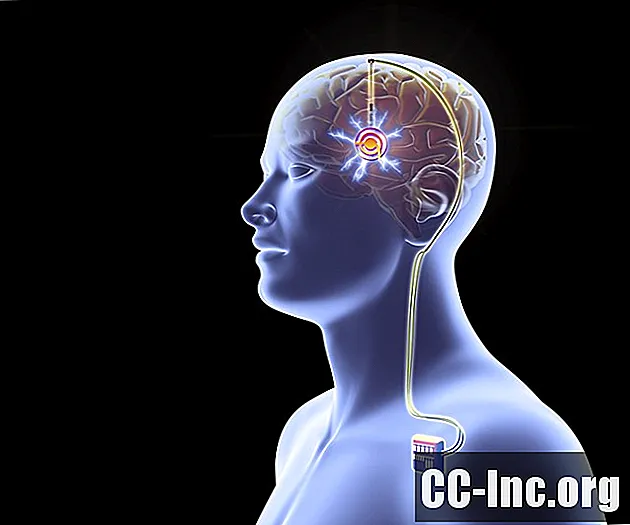La stimolazione cerebrale profonda è efficace nel trattamento del morbo di Alzheimer?