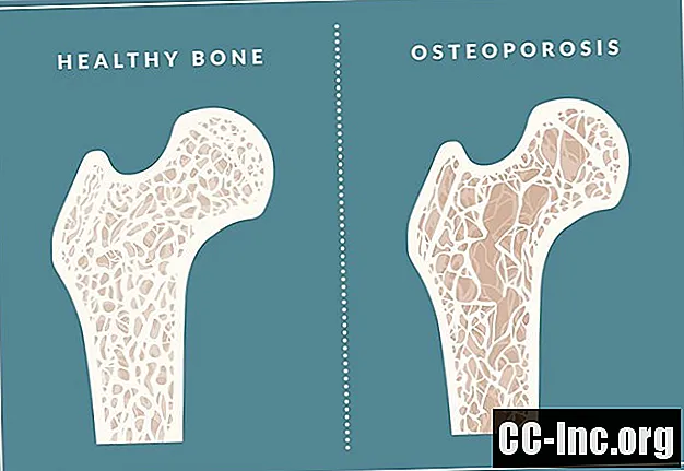 Est-il sécuritaire de prendre Fosamax pour traiter l'ostéoporose?