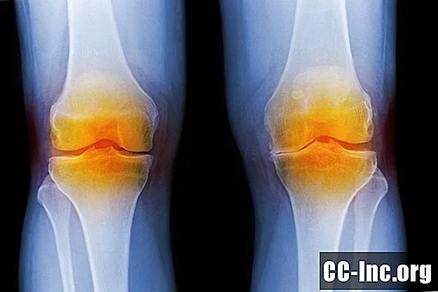 Chirurgia sostitutiva del ginocchio: panoramica