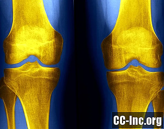 Röntgenfoto's van de knie en het detecteren van afwijkingen