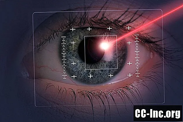 LASIK očesna kirurgija: pregled