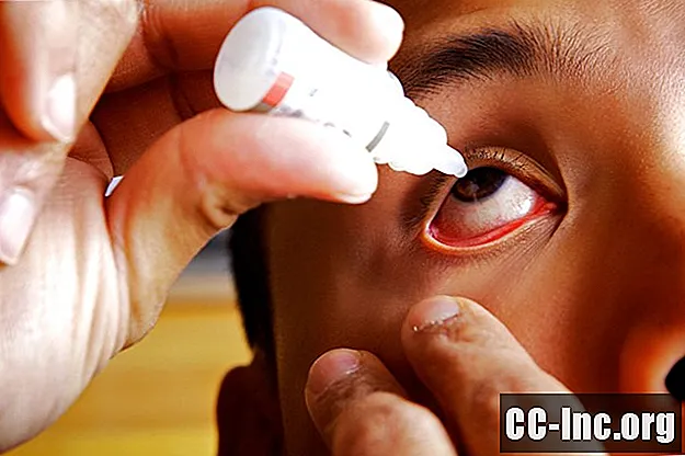 LASIK Göz Cerrahisi: İyileşme - Ilaç