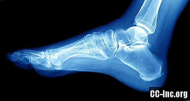 Lateral Malleolus Fracture Symptom and Treatment