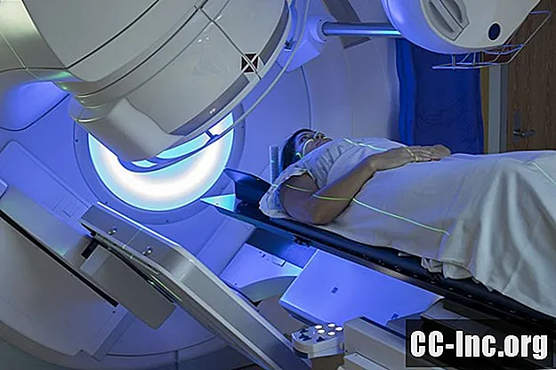Effetti collaterali a lungo termine della radioterapia