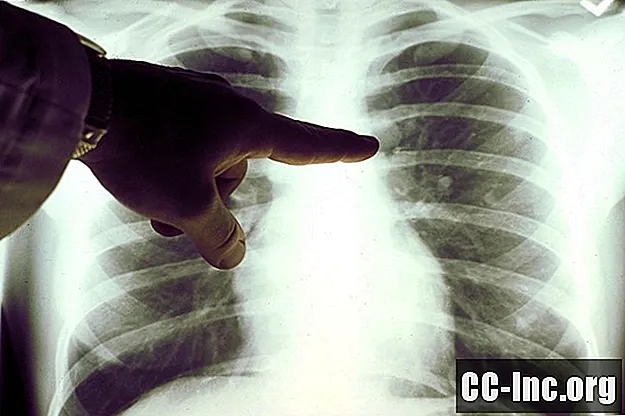 Transplantes de pulmão para tratar DPOC