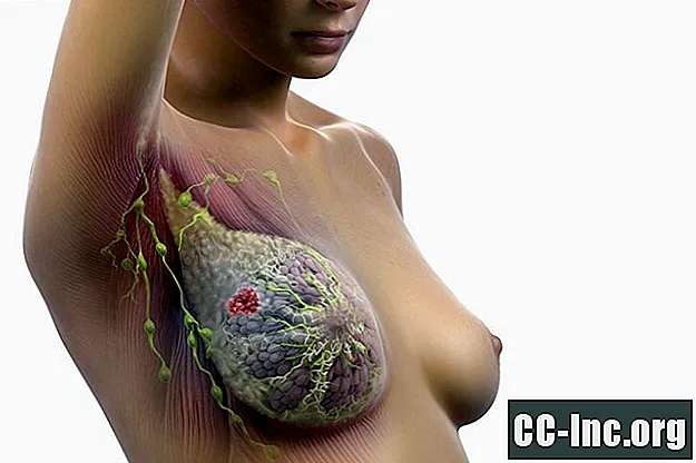 Limfmazgių būklė ir krūties vėžys