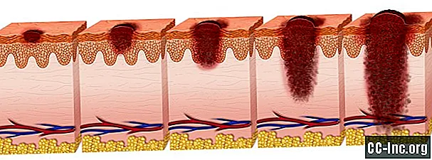 مراحل سرطان الجلد: ما يكشفه كل تشخيص