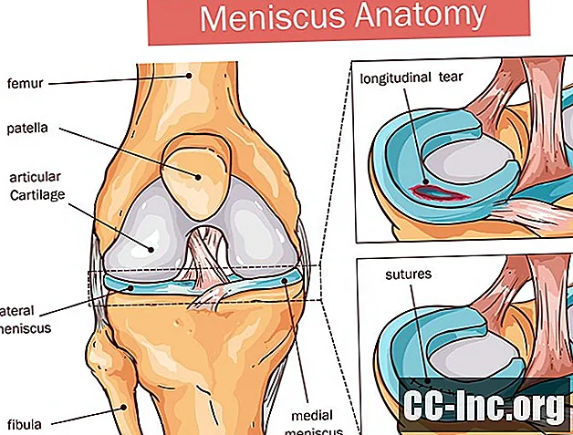Meniskus vs Tulang Belakang Tulang Lutut