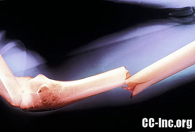 Tratamiento de la fractura del húmero del eje medio