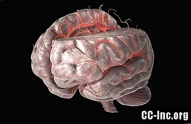 Causas, síntomas y tratamiento del accidente cerebrovascular en la arteria cerebral media