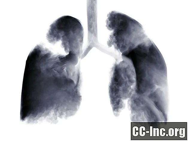 最も一般的なタイプの肺がん