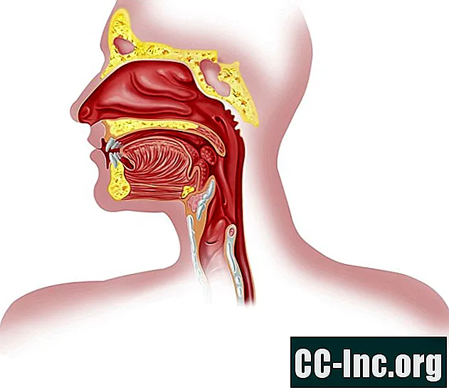 Nasensonde (NG) Tubes und IBD