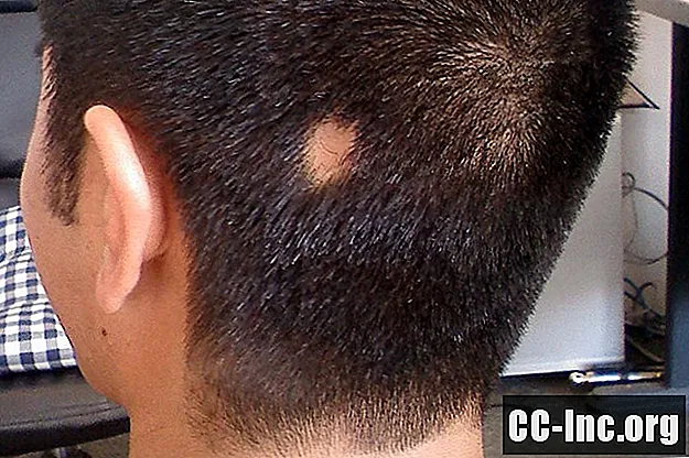 Natuurlijke behandelingen voor Alopecia Areata