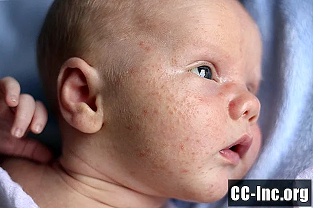 Nyfödd baby acne