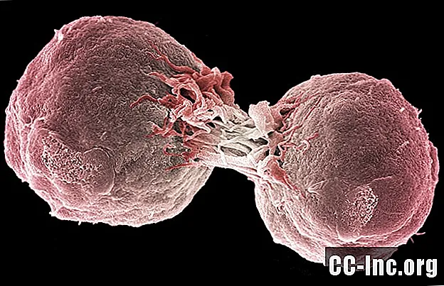 Pregled nodalnega limfoma mejne cone B-celic