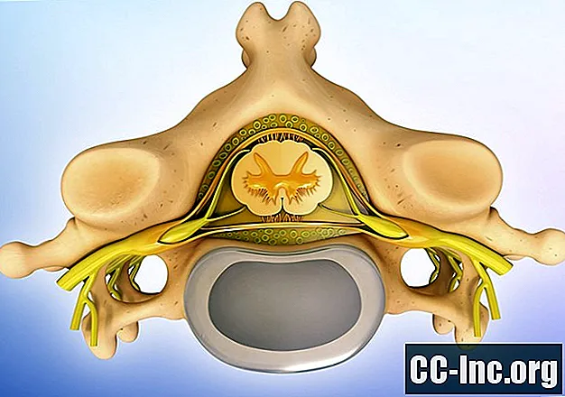 Nucleus pulpos și cum vă ajută coloana vertebrală
