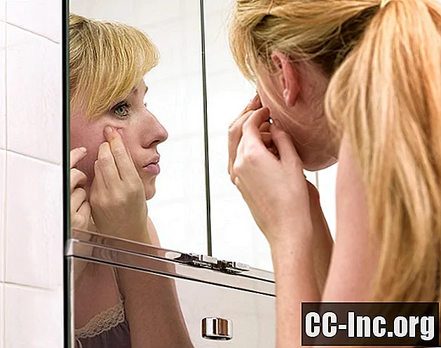 Tratamentos OTC e Prescrição Para Acne Comedonal