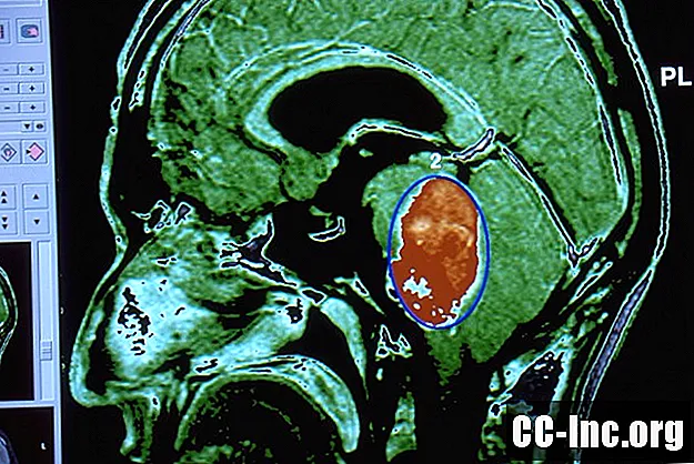 Pregled možganskega raka glioma