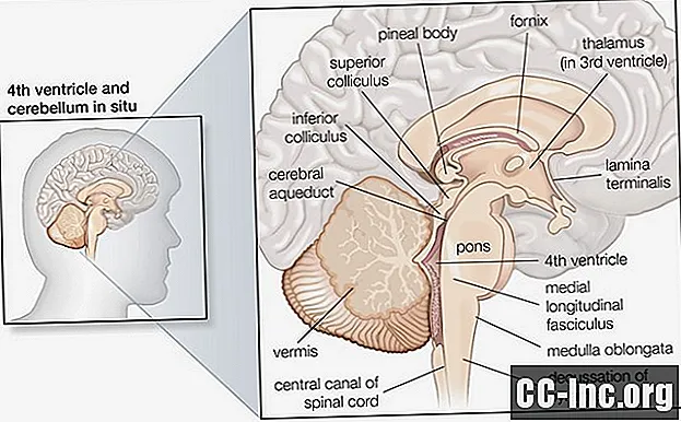 延髄の脳卒中の概要