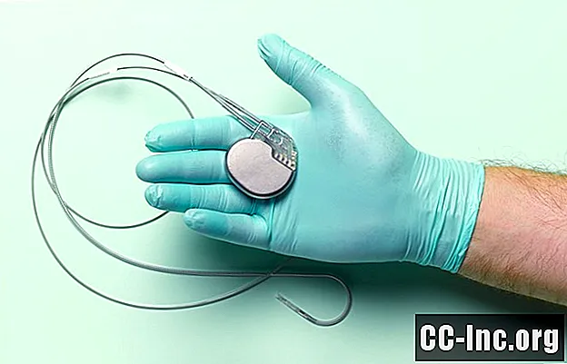 Phẫu thuật cấy máy tạo nhịp tim: Mọi thứ bạn cần biết