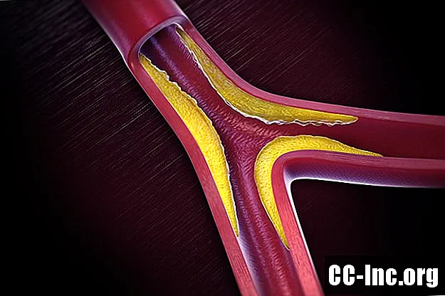 Заболевание периферических артерий
