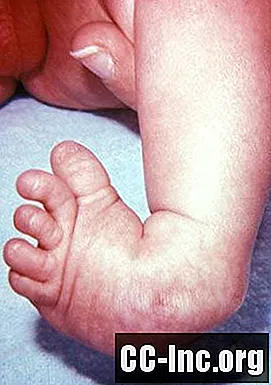 Photos de bébés avec un pied bot
