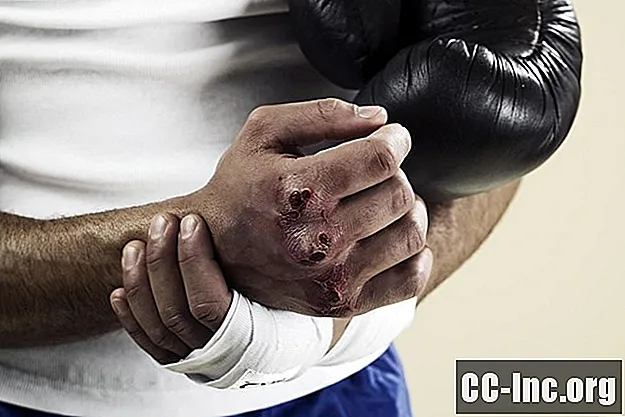 Kinetoterapie după fractura unui boxer