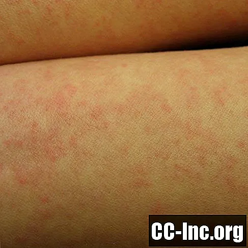 Снимки в помощ при идентифициране на копривна треска срещу други кожни обриви