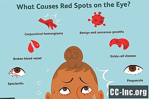 Mulige årsaker til en rød flekk i øyet